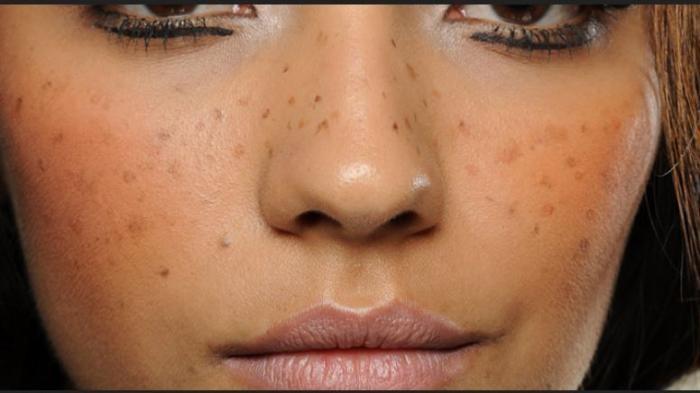 Ketahui Perbedaan Freckles Melasma Dan Flek Hitam